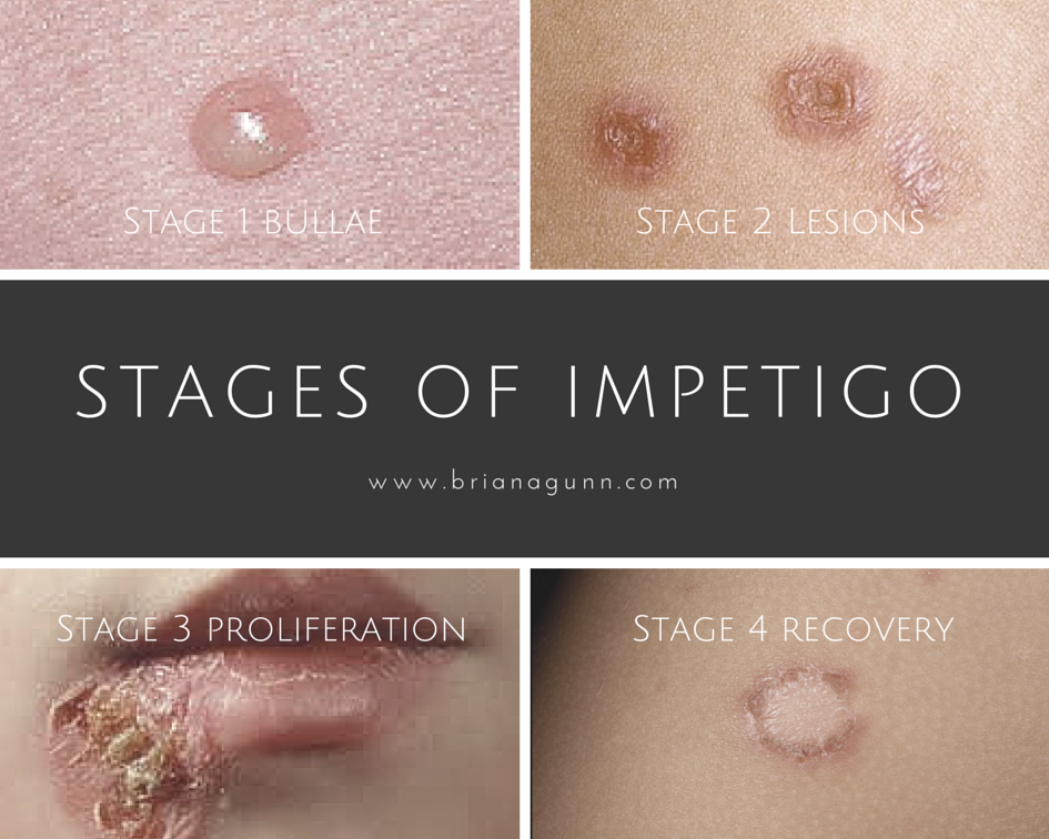 Impetigo lesions Rebuilding health